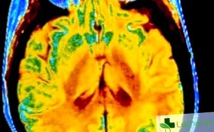 hydrocephalus cerebrospinalis folyadék