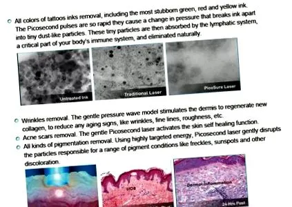 picosecond laser