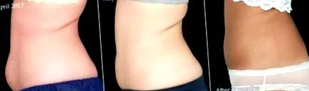 coolsculpting volt