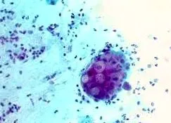 chlamydia leggyakoribb