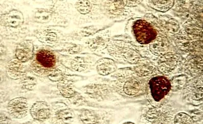 chlamydia fertőzés chlamydia fertőzés
