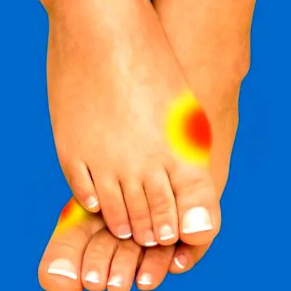 deformitása valgus