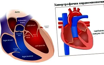 interventricularis septum hipertrófiás kardiomiopátia
