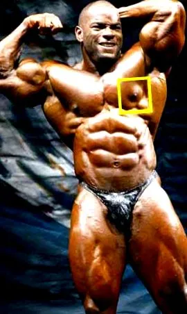 gynecomastia blog