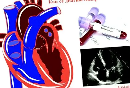 endocarditis