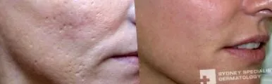 Lézeres fiatalítás Lézeres fiatalítás