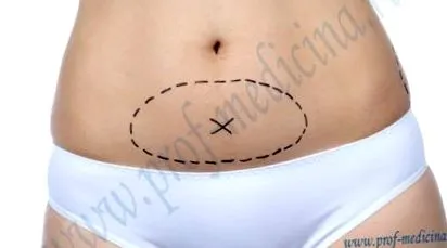 miniabdominoplastika