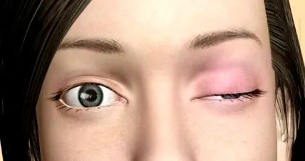 myasthenia gravis myasthenia
