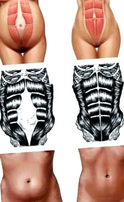 rectus abdominis meghúzhatjuk-e