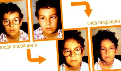 strabismus strabismus