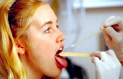 pharyngitis streptococcus fertőzés