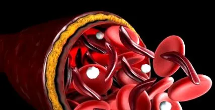 thalassemia kicsi