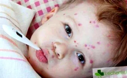 típusai herpes simplex vírus