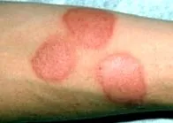 allergiás