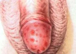 Balanitis koplalás balanoposthitis