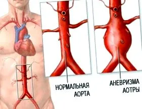 tünetei aorta