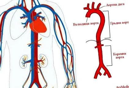 aortitis