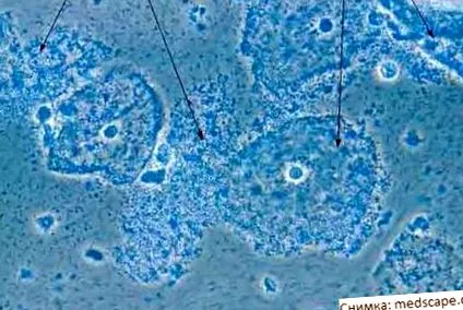 anaerob gardnerella