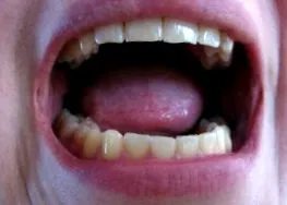 halitosis halitosis