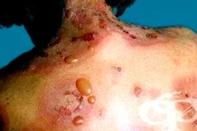 Bullous pemphigoid pemphigoid