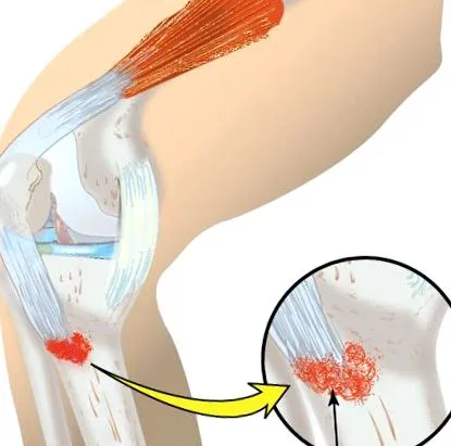 osgood-schlatter osgood-schlatter