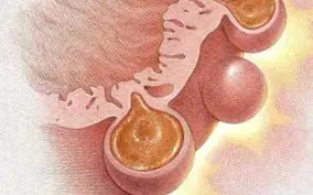 sigmoid vastagbél