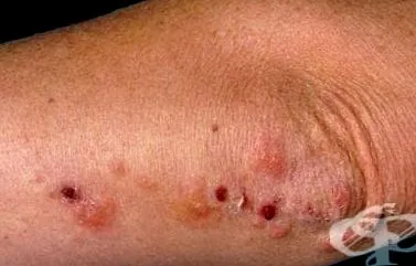 bullous pemphigoidot Dermatitis herpetiformis