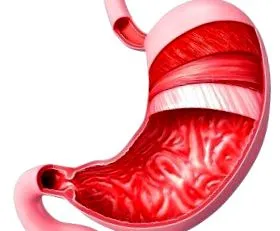 gastritis