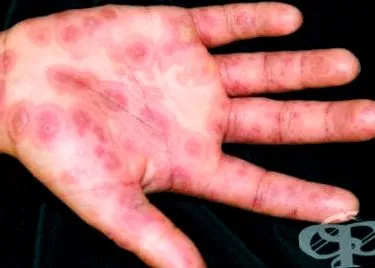 nemi szervek Erythema multiforme