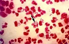 egészségügyi gonorrhoea