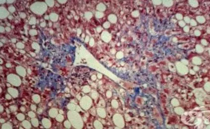 vírusos hepatitis májfibrózis