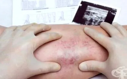 lokalizációval phlebitis