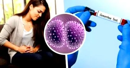 kezelés gonorrhoea