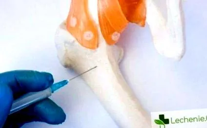 tünetek hematogén osteomyelitis