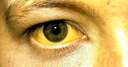 hepatitis ayurveda