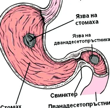 gyomorfekély gyomorfekély