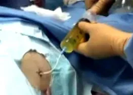 hogyan ascites hogyan