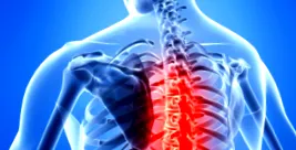 spondylosis hogyan