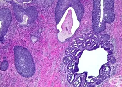 nyaki intraepithelialis