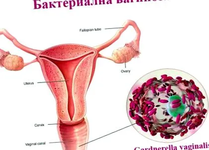 vaginosist