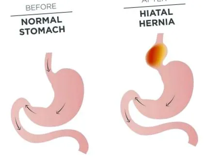 hiatal műtétről