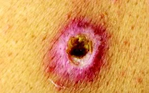 rosszindulatú melanoma