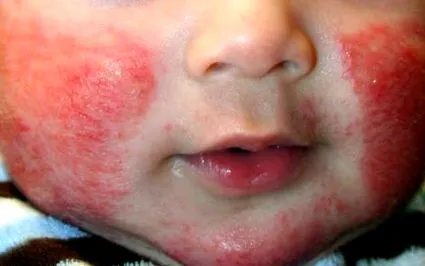 derma kezelése