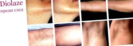 derm arcszőrtelenítés