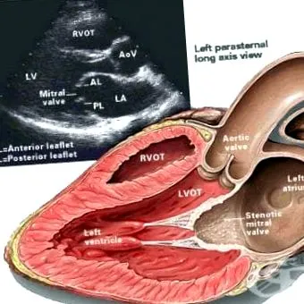 stenosis stenosis