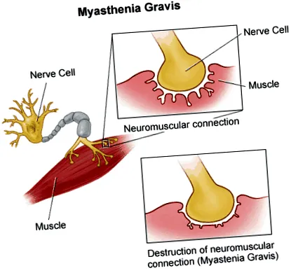 gravis myasthenia
