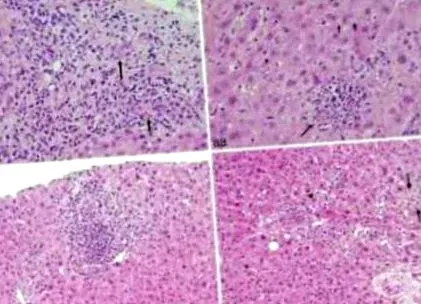 gyógyszer által kiváltott által kiváltott hepatitis