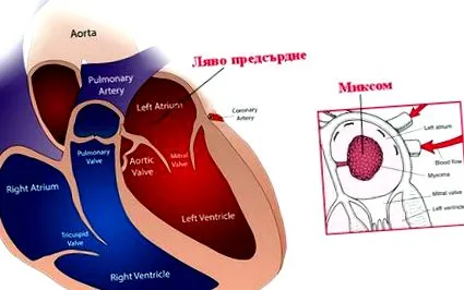myxoma jóindulatú