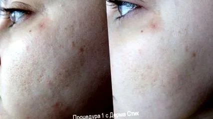 kísérletem derma