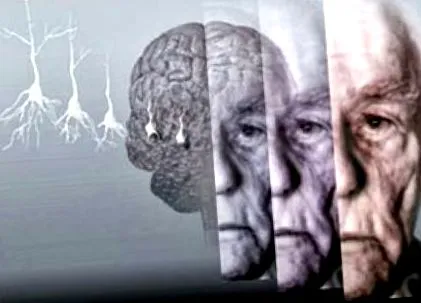alzheimer-kór legjobb